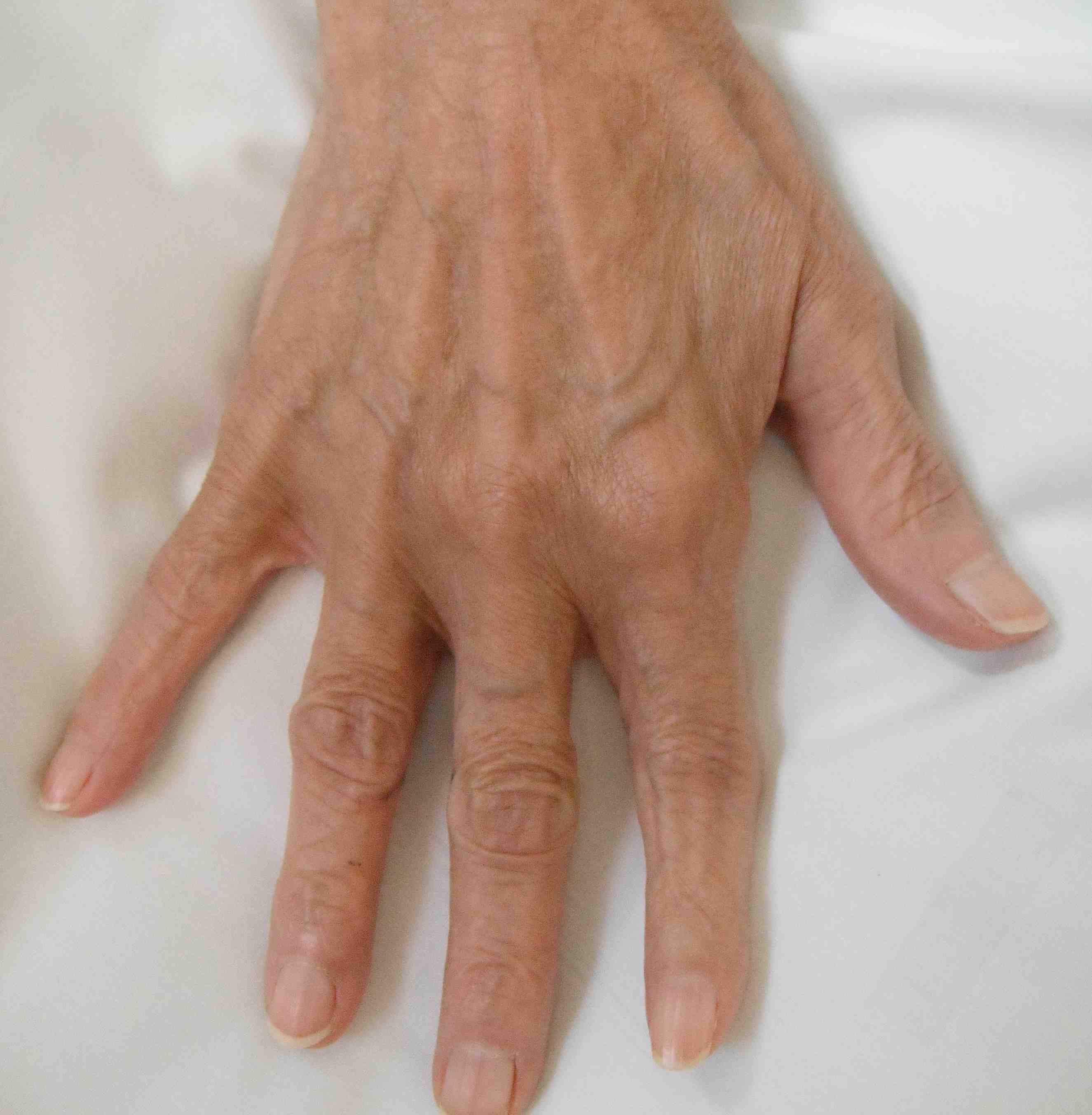 Rheumatoid Boutonniere Finger
